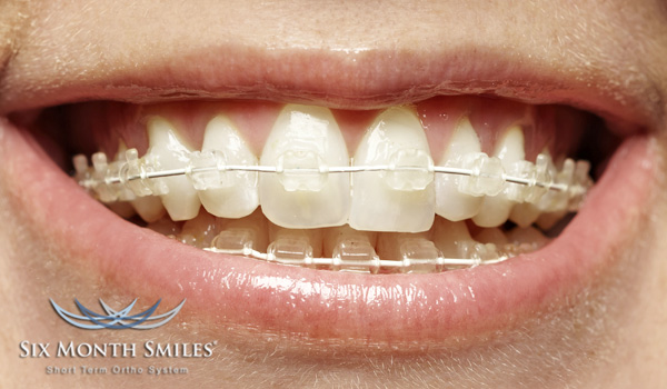 six-month-smiles-brace.jpg